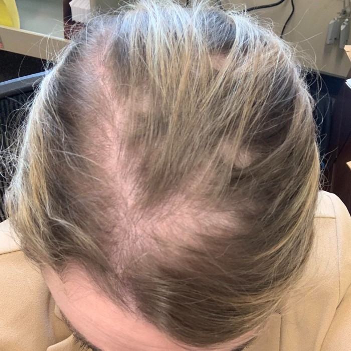 accutane hair loss permanent
