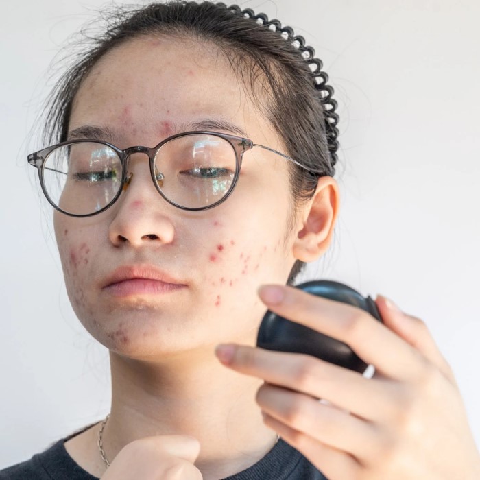 accutane hair loss permanent